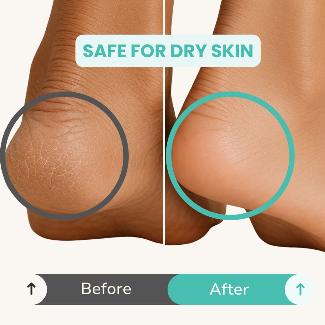 Before and after comparison of dry skin on a person's knee with 'Safe for Dry Skin' text.
